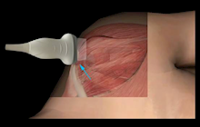 肌骨超声引导介入技术，让疼痛治疗更安全、更精准、更高效！