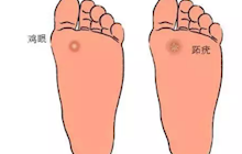 鸡眼、跖疣，傻傻分不清，一文教您正确区分！