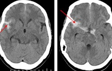 头痛头晕还恶心，别大意！脑血管造影（DSA）检查有必要